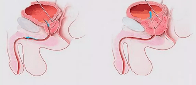 Segni di prostatite negli uomini