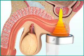 Trattamento della prostatite