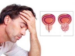 Prostatite in un uomo