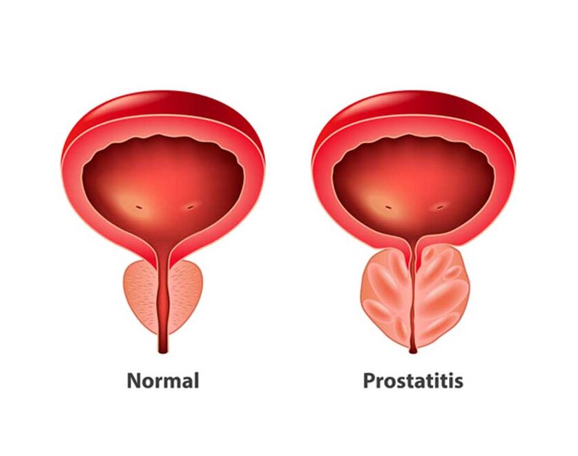 prostata normale e infiammatoria