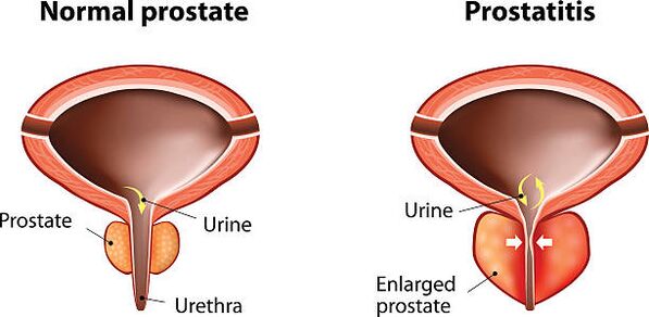 prostata normale e infiammata